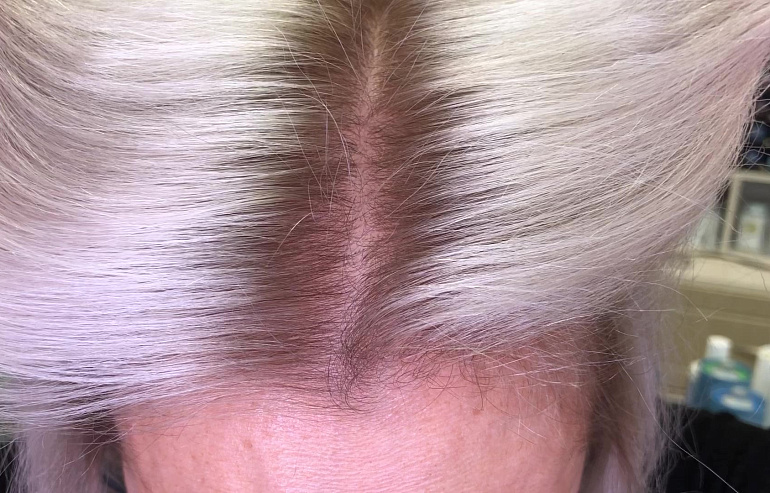 Результат окрашивания - затемнение блонда у корней по модели "Бейби Лайтс"